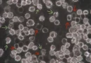 Krevní kataklyzma! Krev neočkovaných se rozpadá, lepí, plují v ní tisíce nanočipů