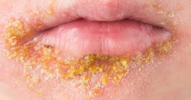 Zejména v Chorvatsku napadá lidi impetigo, co z homeopatik nasadit?