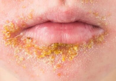 Zejména v Chorvatsku napadá lidi impetigo, co z homeopatik nasadit?